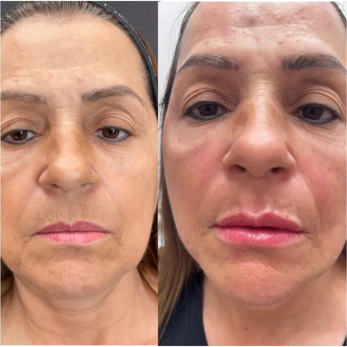 Antes e depois · rosto