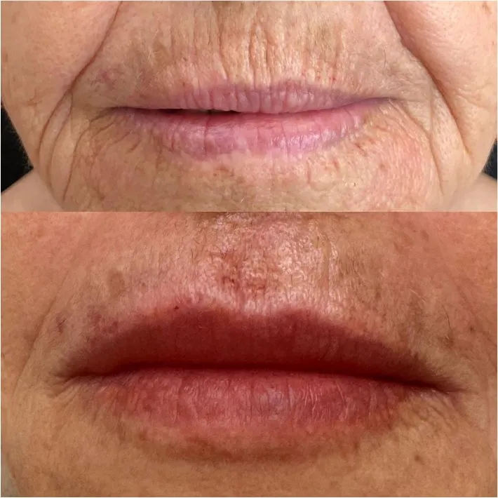 Antes e depois · lábios