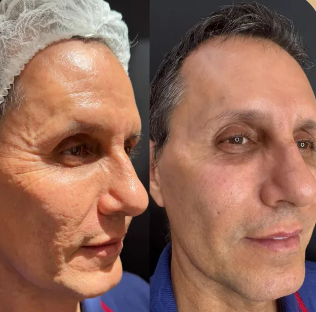 Rejuvenescimento facial · antes e depois