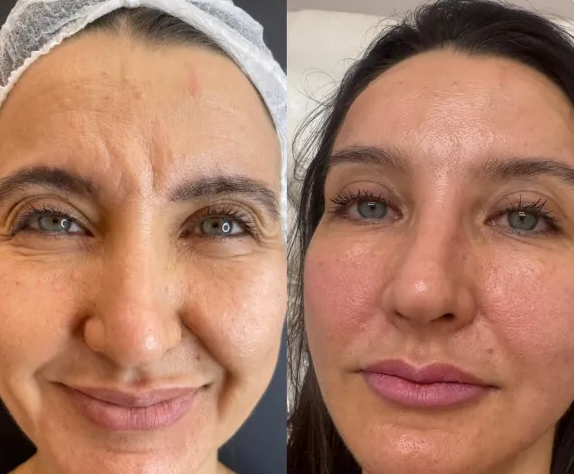 Transformação facial · antes e depois