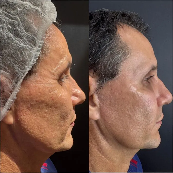 Antes e depois · perfil
