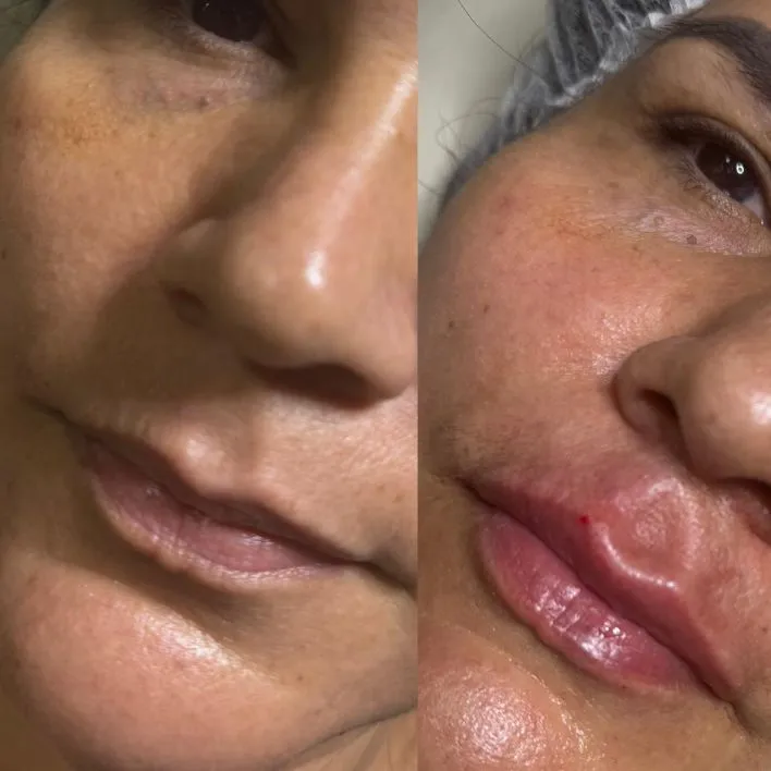 Antes e depois · lábios